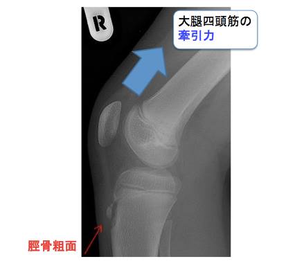 成長期の膝での障害、オスグッド病の予防